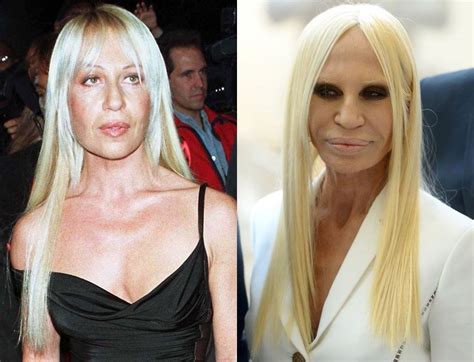 donatelal versace|donatella versace before and after surgery.